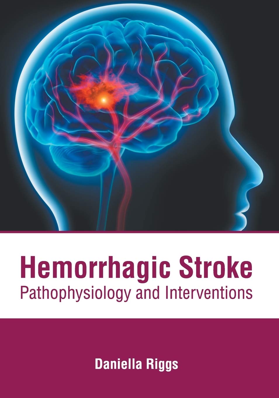 Hemorrhagic Stroke Medicine