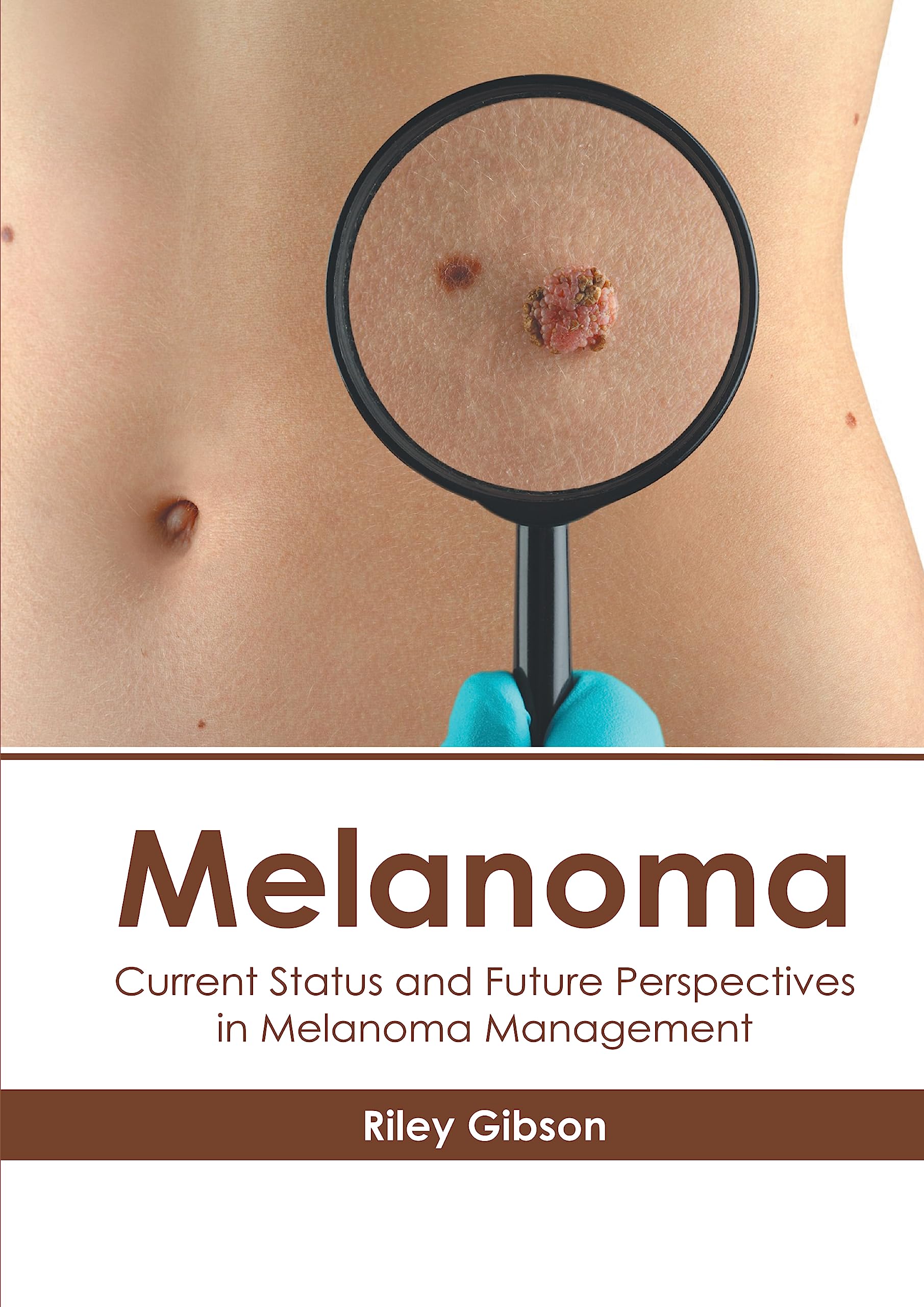 Melanoma: Current Status and Future Perspectives in Melanoma Management Medicine