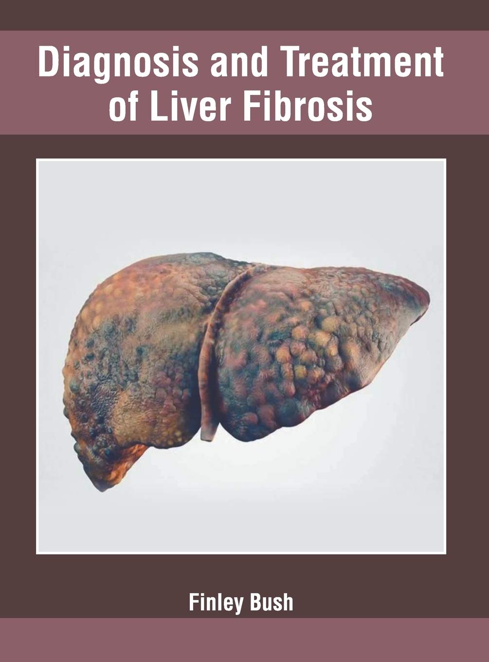 Diagnosis and Treatment of Liver Fibrosis Medicine