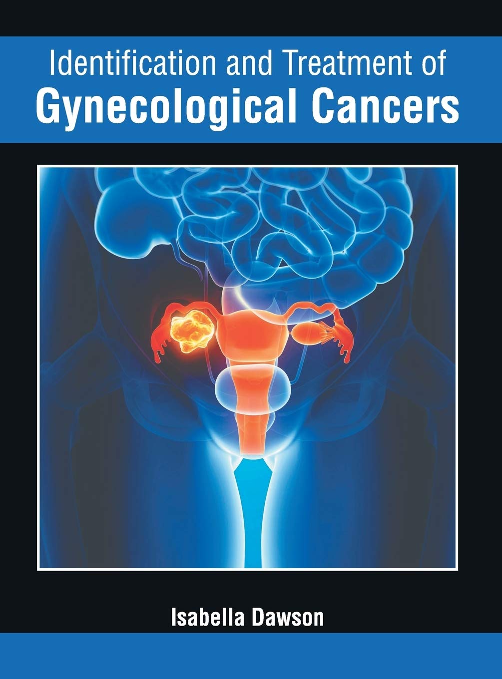 Identification and Treatment of Gynecological Cancers Medicine