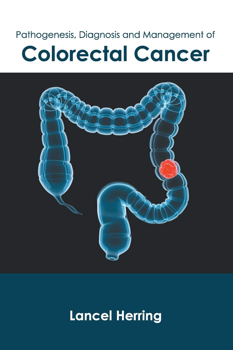 Pathogenesis, Diagnosis and Management of Colorectal Cancer Medicine