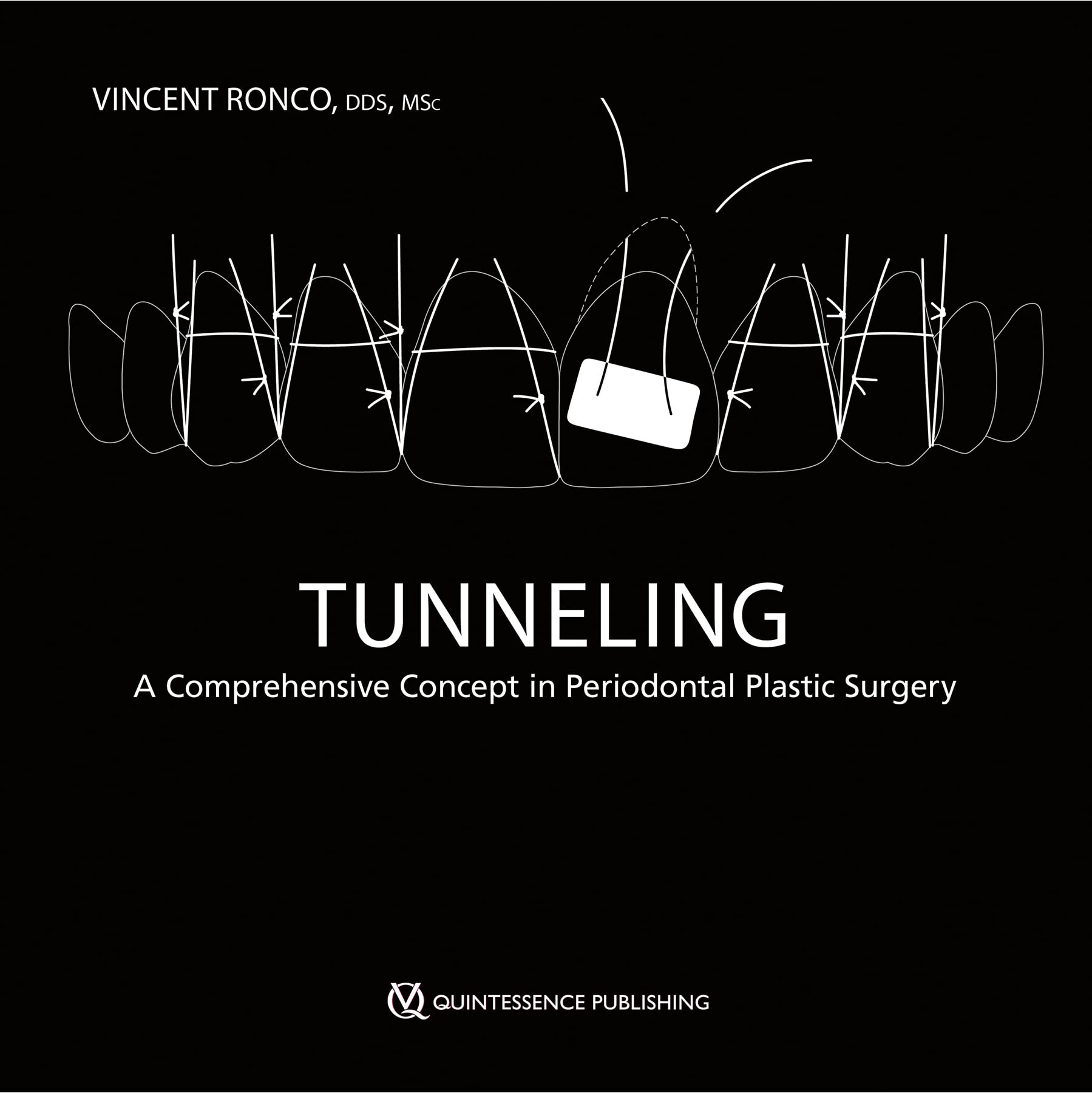 Tunneling: A Comprehensive Concept in Periodontal Plastic Surgery Medicine