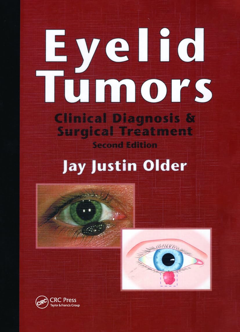 Eyelid Tumors: Clinical Diagnosis and Surgical Treatment Medicine