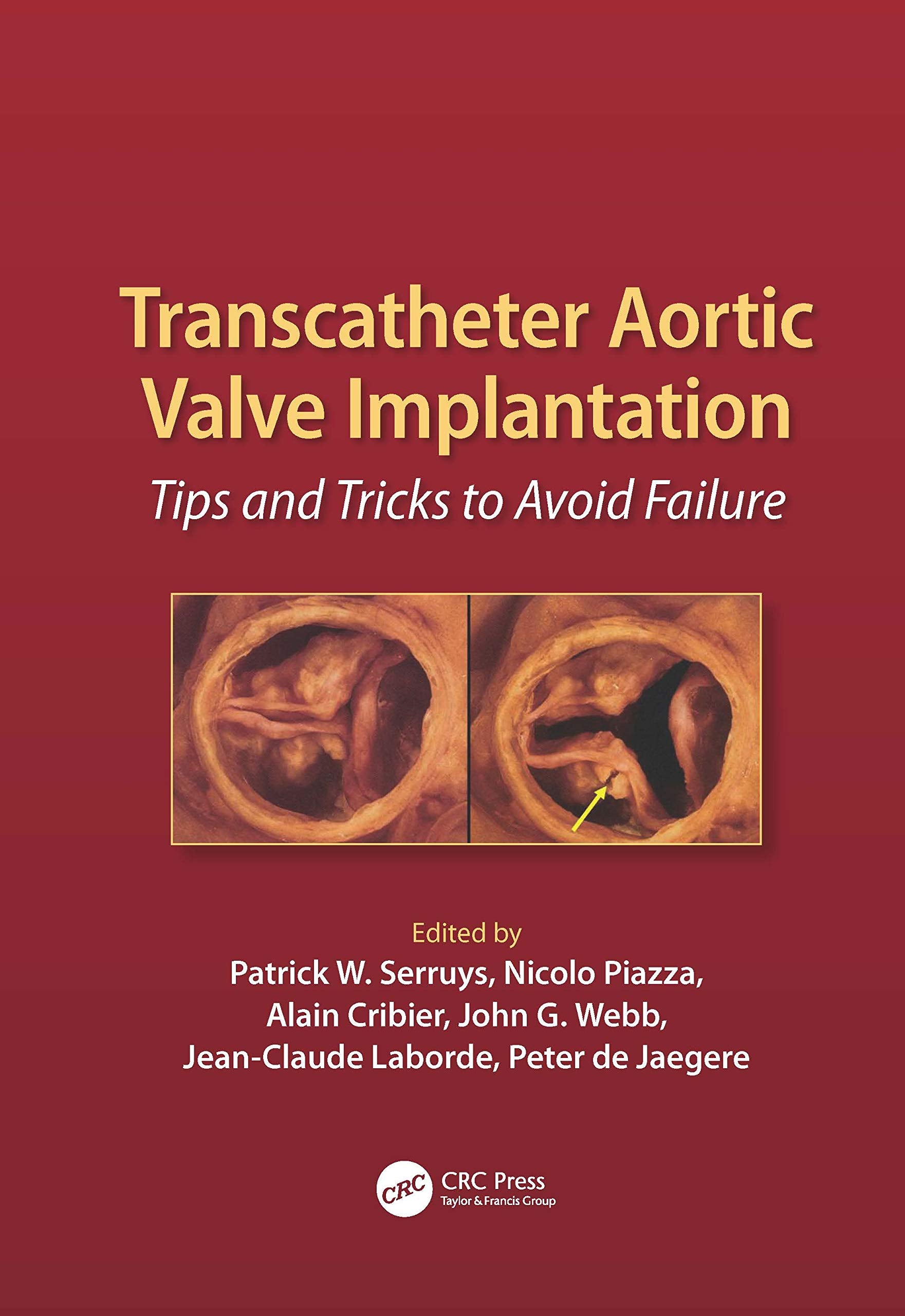 Product Image: Transcatheter Aortic Valve Implantation