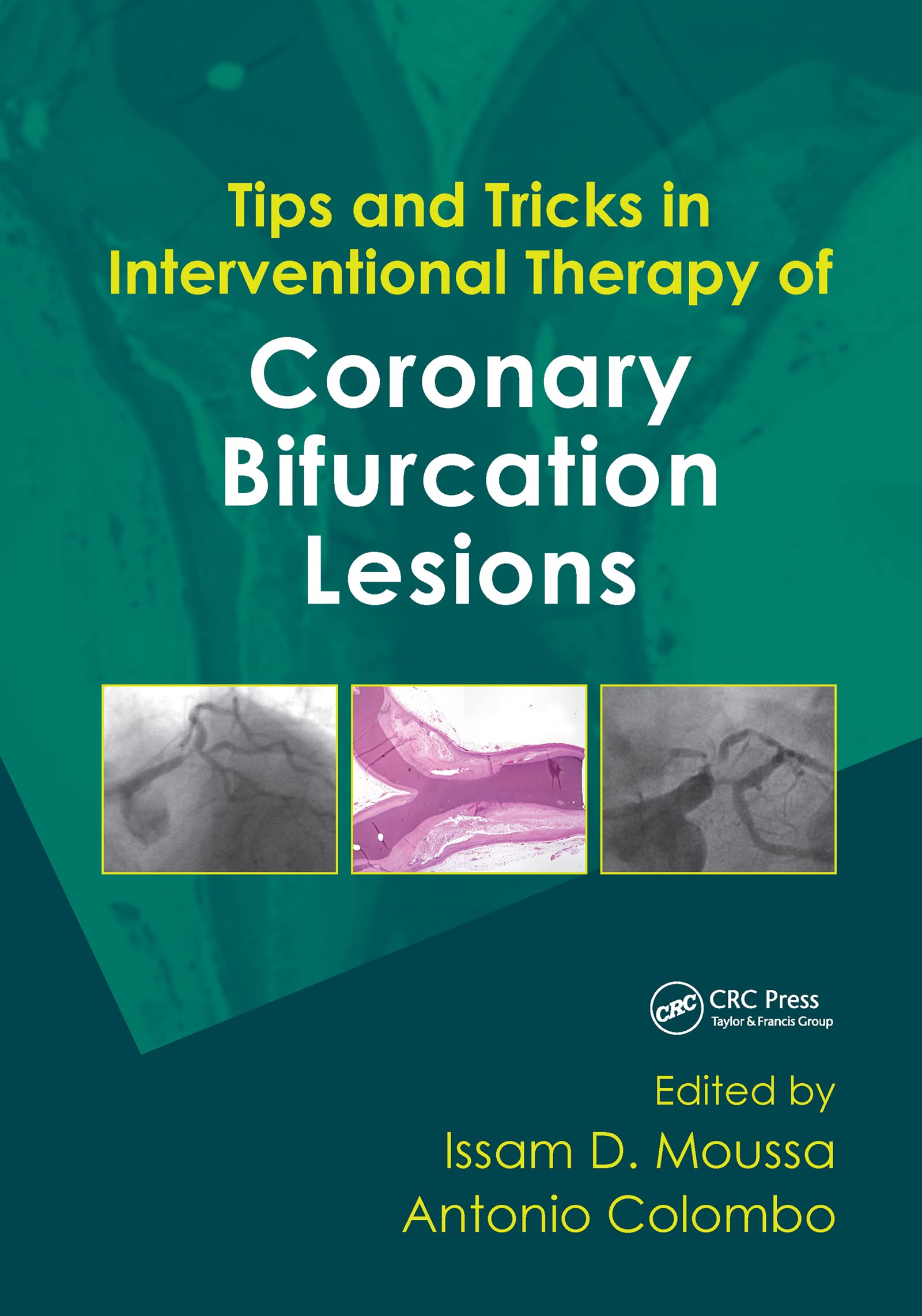Tips and Tricks in Interventional Therapy of Coronary Bifurcation Lesions Medicine