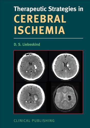 Cerebral Ischemia (Therapeutic Strategies) Medicine