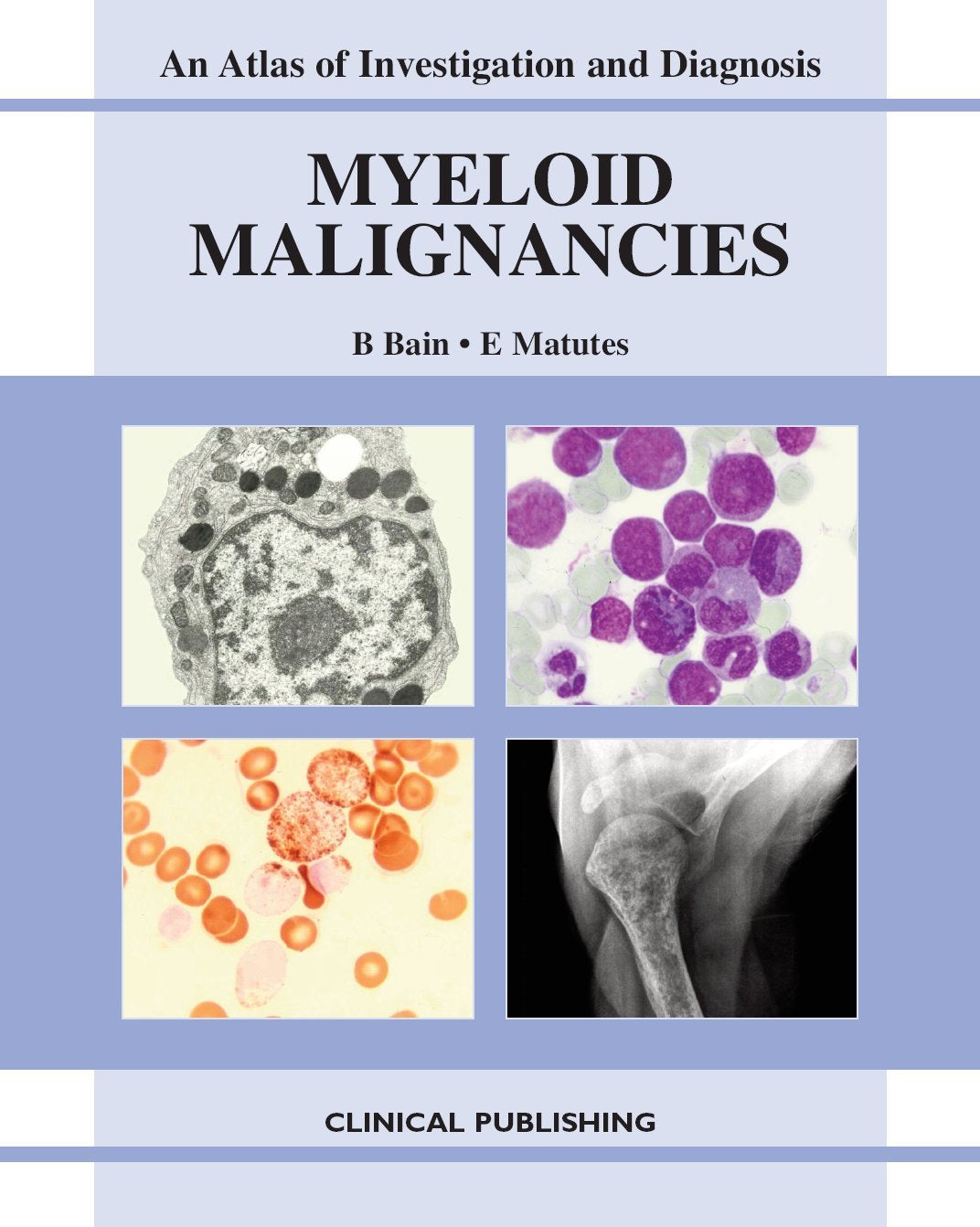 Myeloid Malignancies (Atlas of Investigation and Diagnosis) Medicine