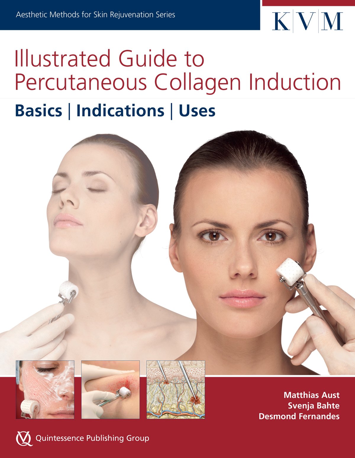 Illustrated Guide to Percutaneous Collagen Induction: Basics | Indications | Uses (Aesthetic Methods for Skin Rejuvenation) Medicine
