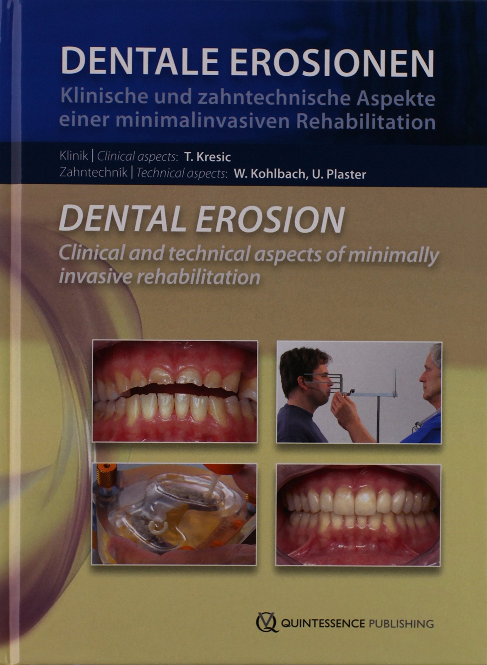 Dental Erosion: Clinical and Technical Aspects of Minimally Invasive Rehabilitation Books