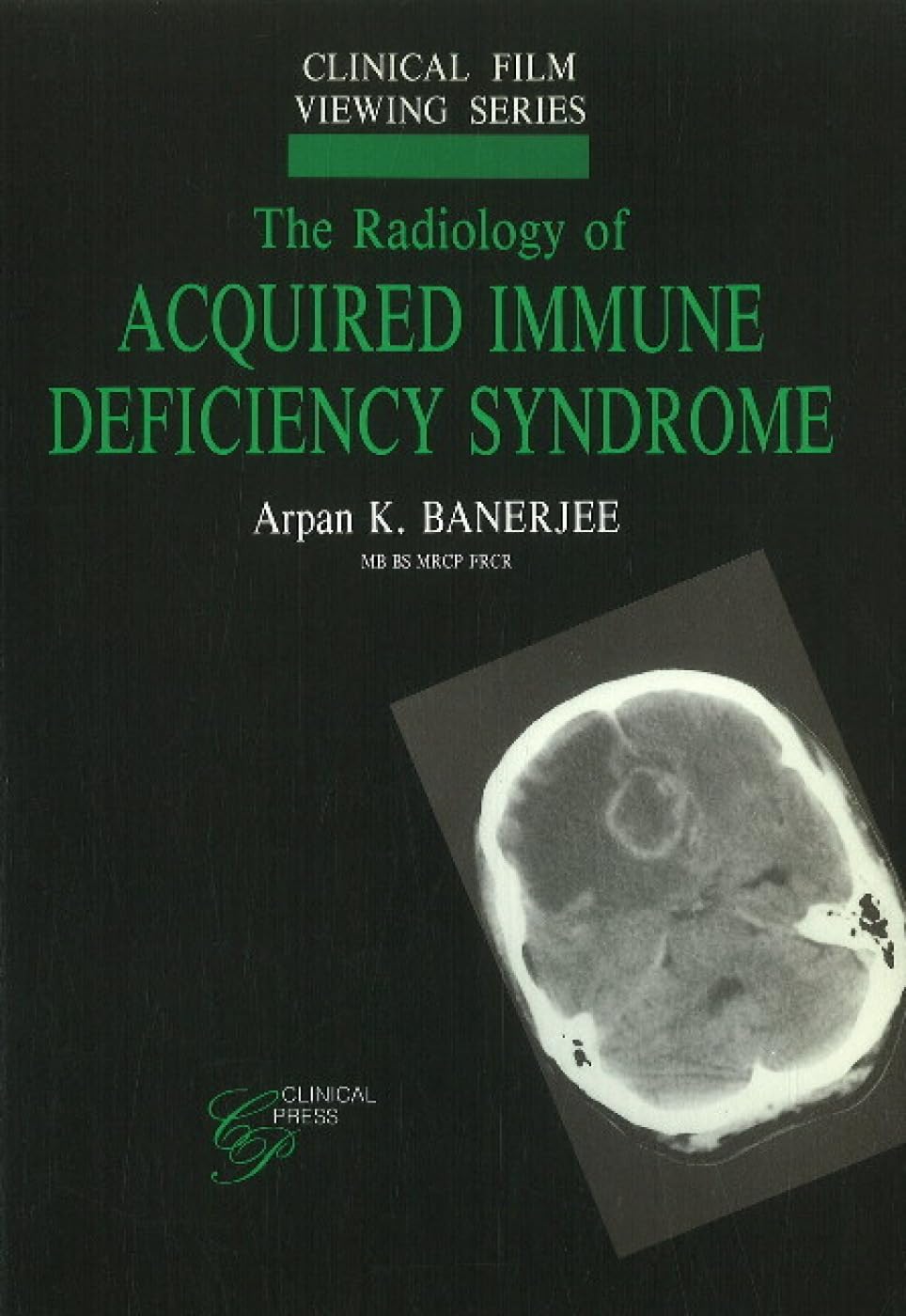 Radiology of Acquired Immune Deficiency Syndrome (Clinical Film Viewing) Medicine