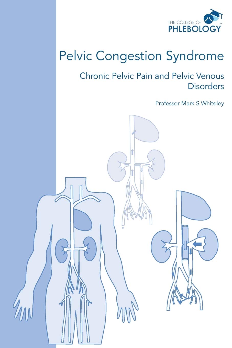 Pelvic Congestion Syndrome - Chronic Pelvic Pain and Pelvic Venous Disorders Medicine