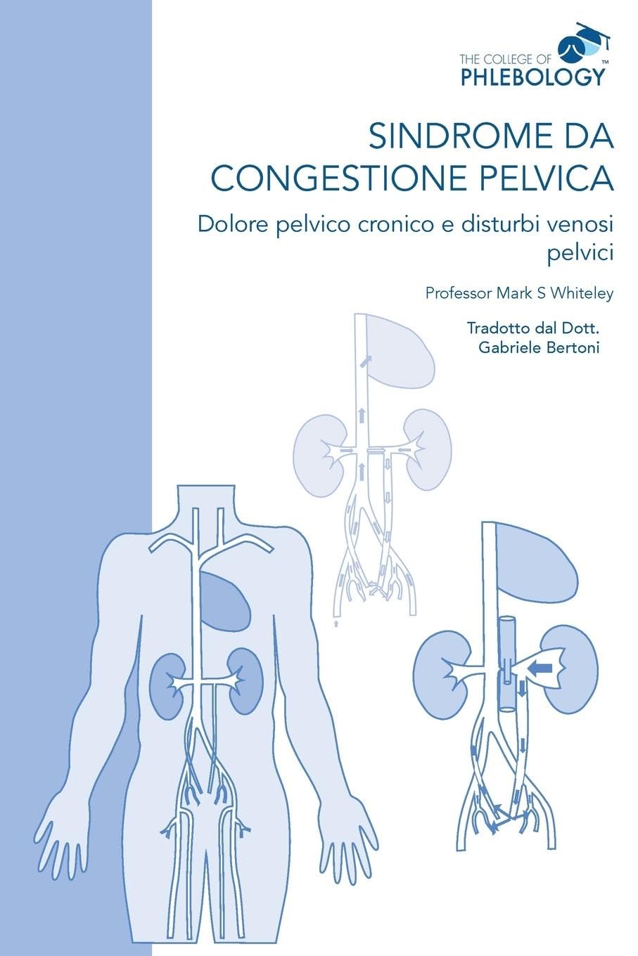 Sindrome da congestione pelvica - Dolore pelvico cronico e disturbi venosi pelvici Medicine