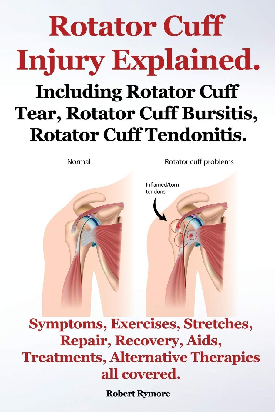 Rotator Cuff Injury Explained. Including Rotator Cuff Tear, Rotator Cuff Bursitis, Rotator Cuff Tendonitis. Symptoms, Exercises, Stretches, Repair, Re Medicine