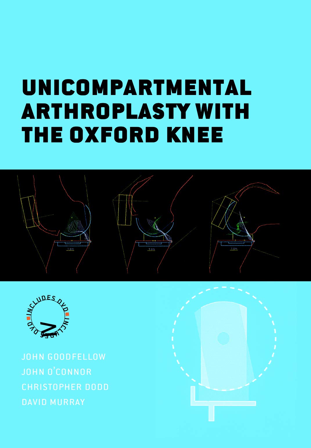 Unicompartmental Arthroplasty With the Oxford Knee Medicine