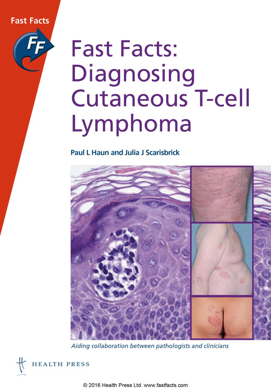 Fast Facts: Diagnosing Cutaneous T-Cell Lymphoma Medicine