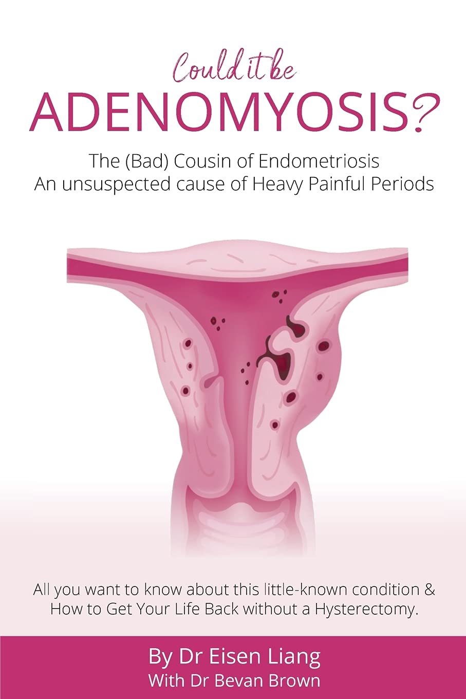 Adenomyosis -The Bad Cousin of Endometriosis: An unsuspected cause of Heavy Painful Periods Medicine