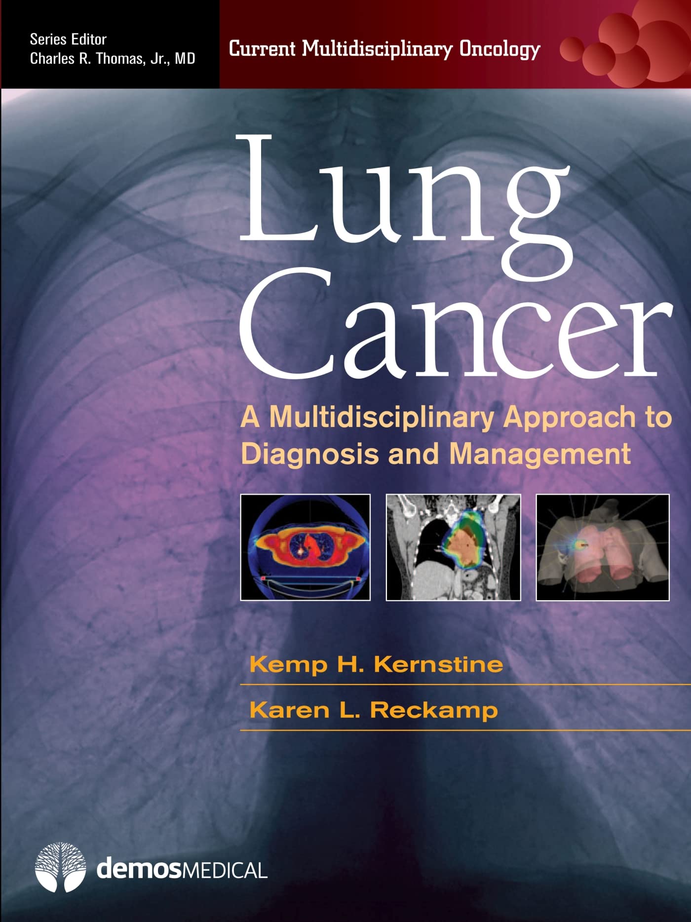 Lung Cancer: A Multidisciplinary Approach to Diagnosis and Management book