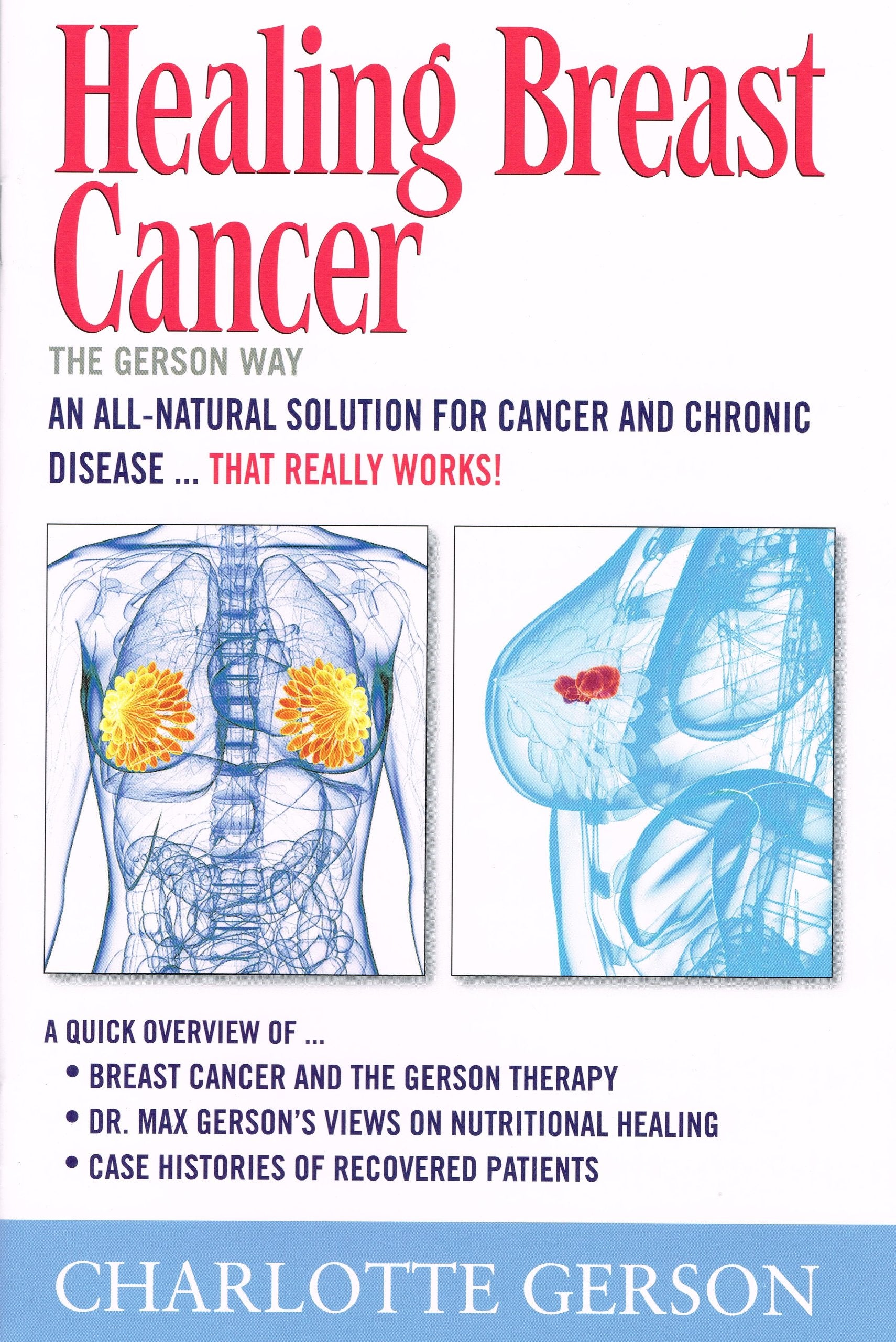 Healing Breast Cancer - The Gerson Way Medicine