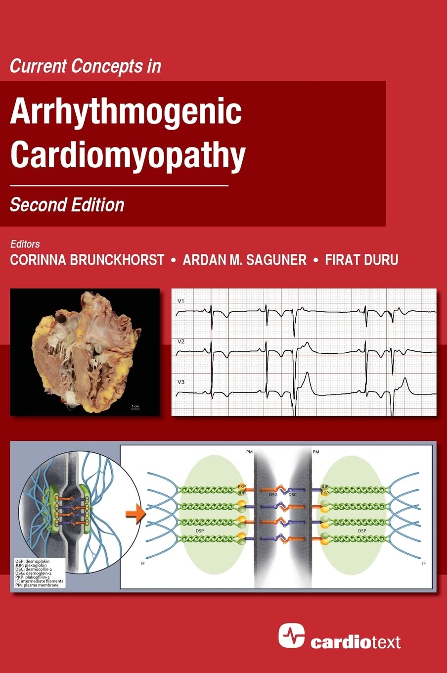 Current Concepts in Arrhythmogenic Cardiomyopathy, Second Edition Medicine