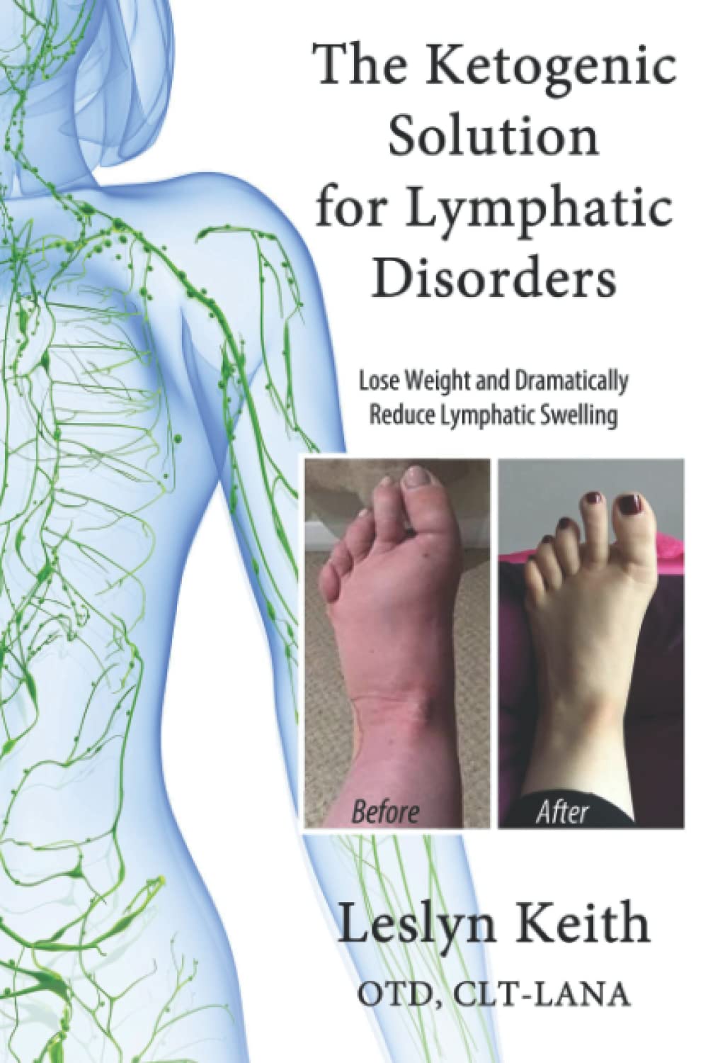 The Ketogenic Solution for Lymphatic Disorders: A Proven Way to Lose Weight and Reduce Lymphatic Swelling Health, Nutrition & Fitness