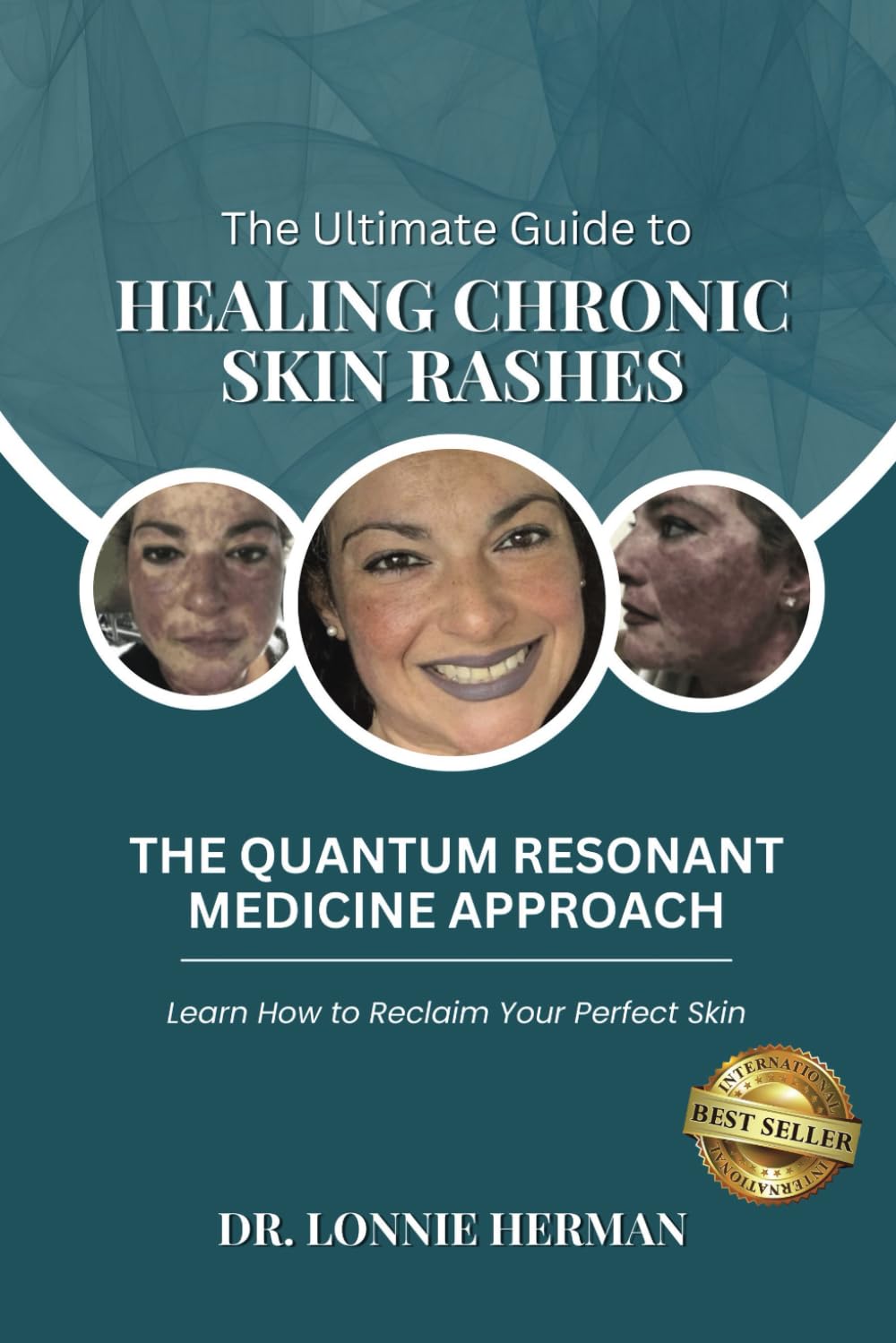 The Ultimate Guide To Healing Chronic Skin Rashes: The Quantum Resonant Medicine Approach - Learn How To Reclaim Your Perfect Skin Health, Nutrition & Fitness
