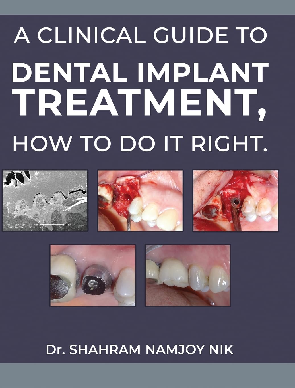 A guide to dental implant treatment, how to do it right. Medicine