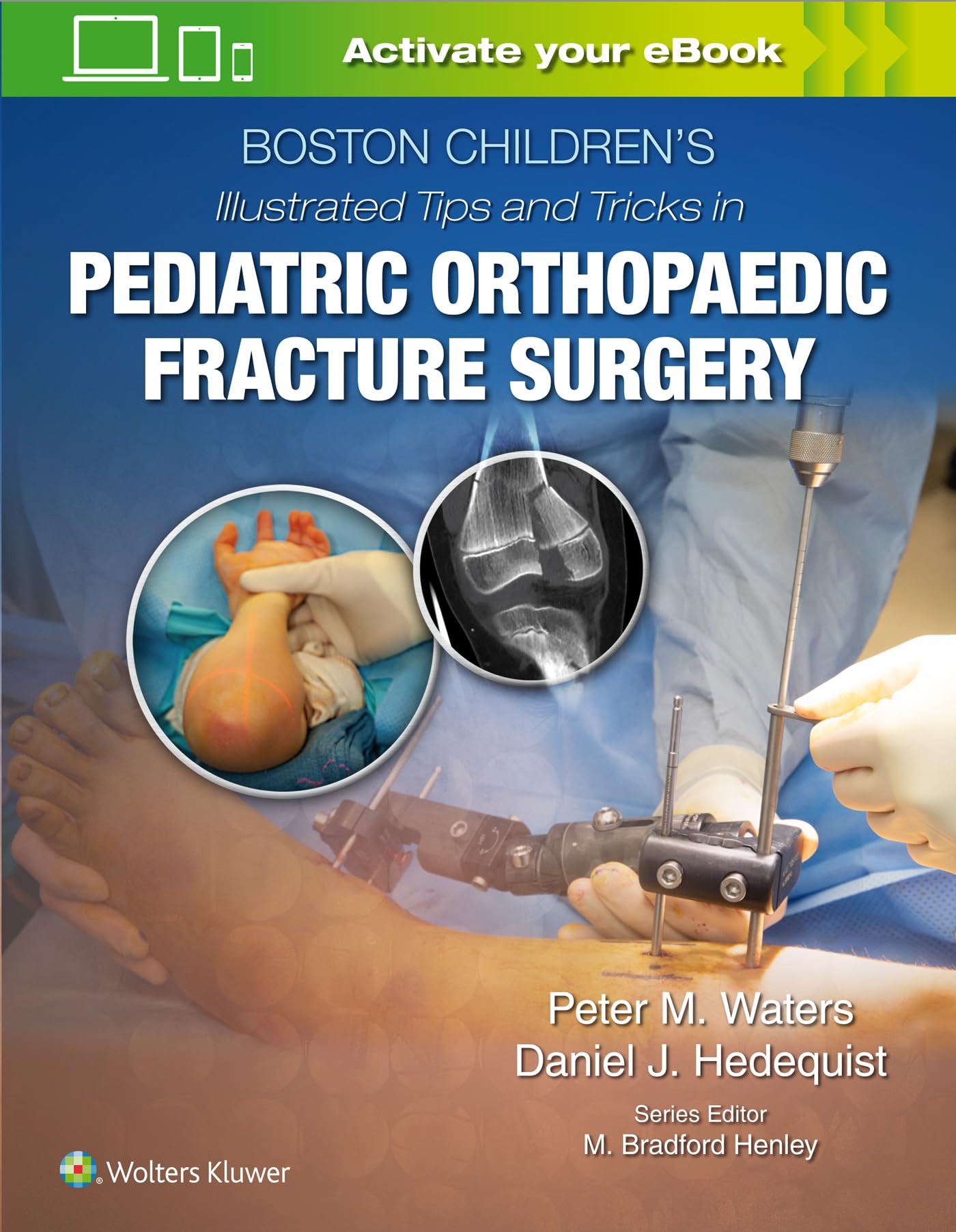 Boston Children’s Illustrated Tips and Tricks in Pediatric Orthopaedic Fracture Surgery Medicine