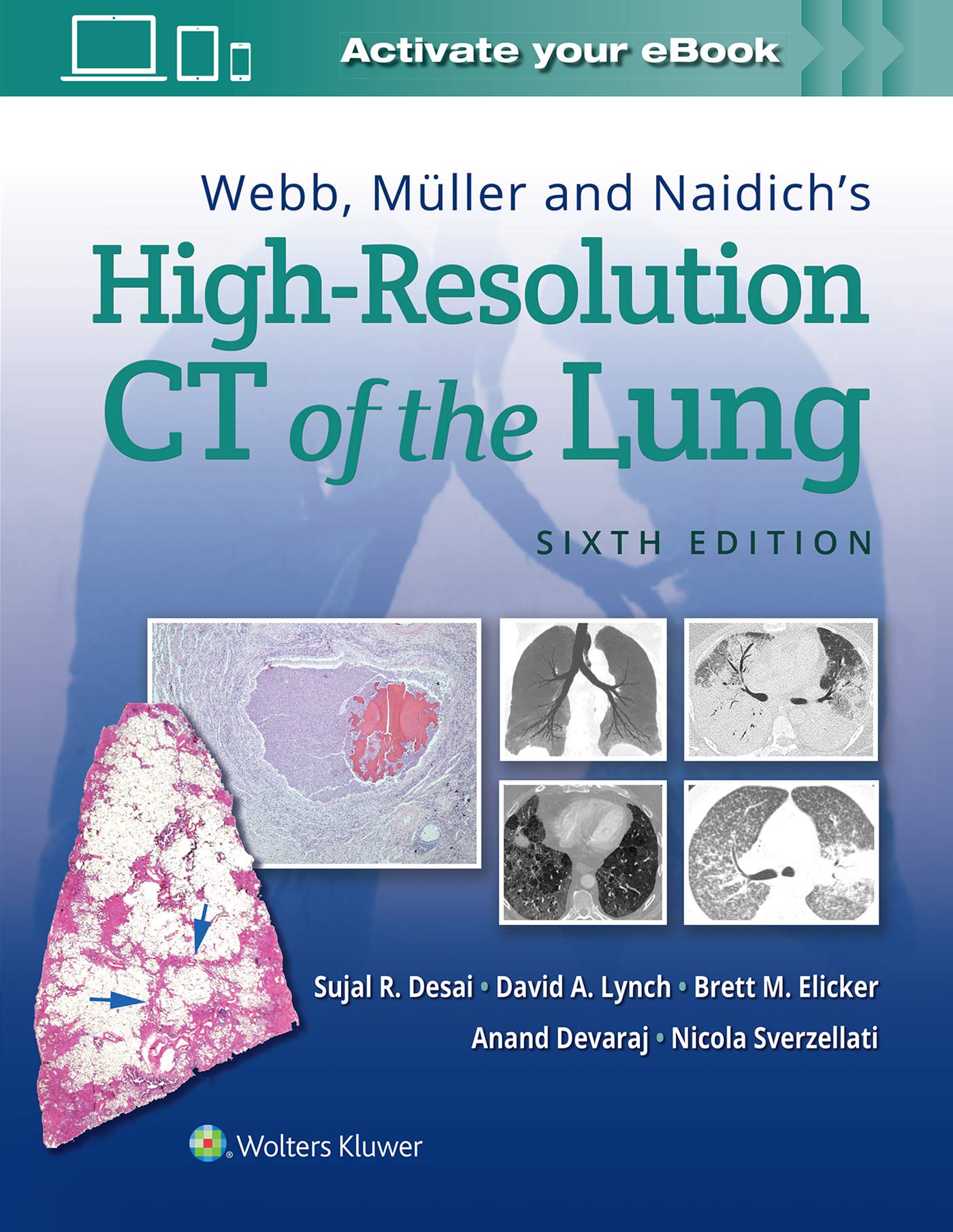 Webb, Muller and Naidich's High Resolution of Lung CT Medicine