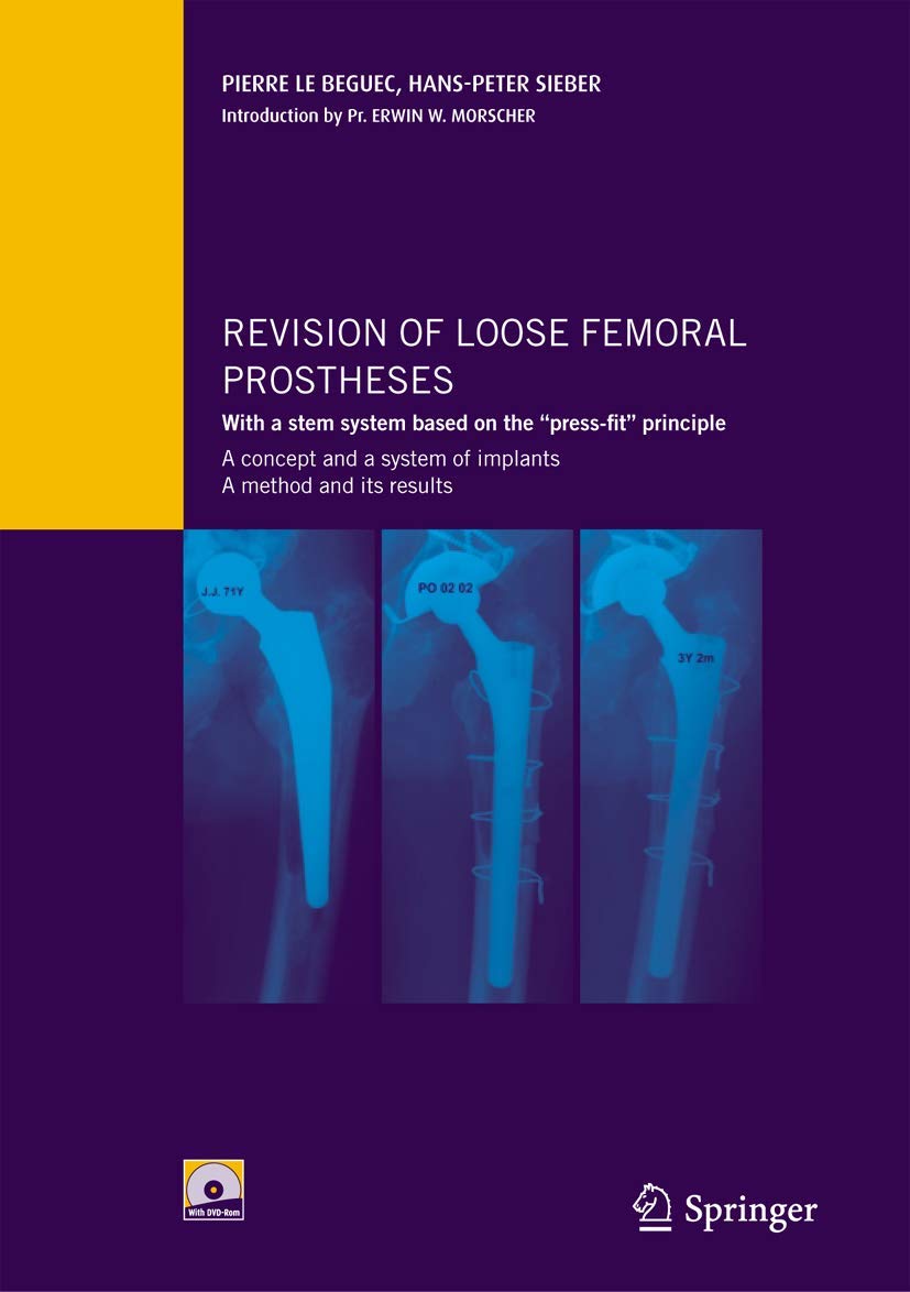 Revision of loose femoral prostheses with a stem system based on the "press-fit" principle: A concept and its system of implants, a method and its results book