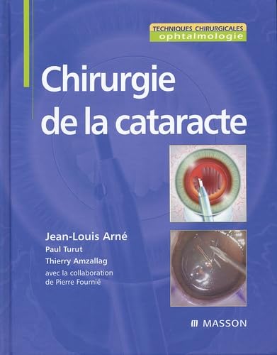 Chirurgie de la cataracte book