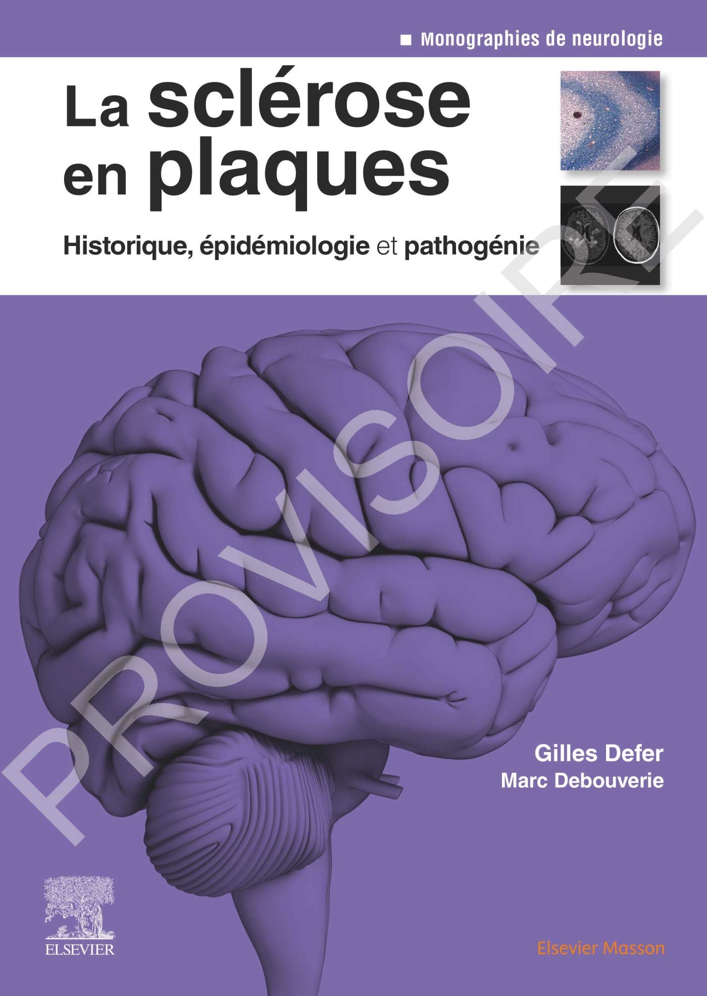 La sclérose en plaques - Historique, épidémiologie et pathogénie: Epidemiol Et Pathogenie Medicine