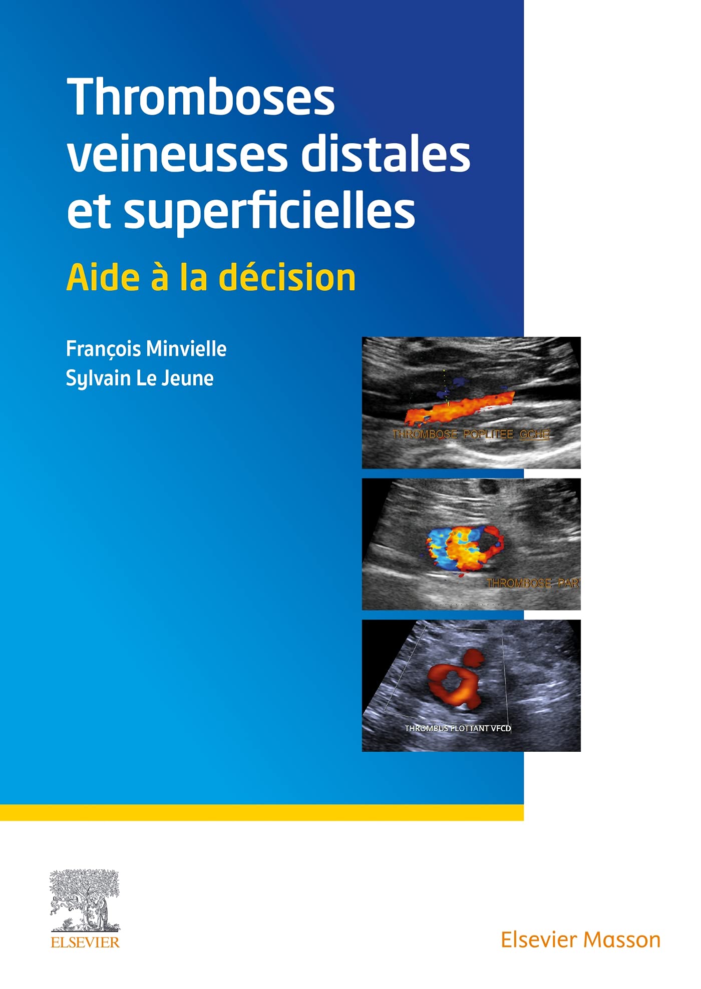Thromboses veineuses distales et superficielles: Aide à la décision Medicine