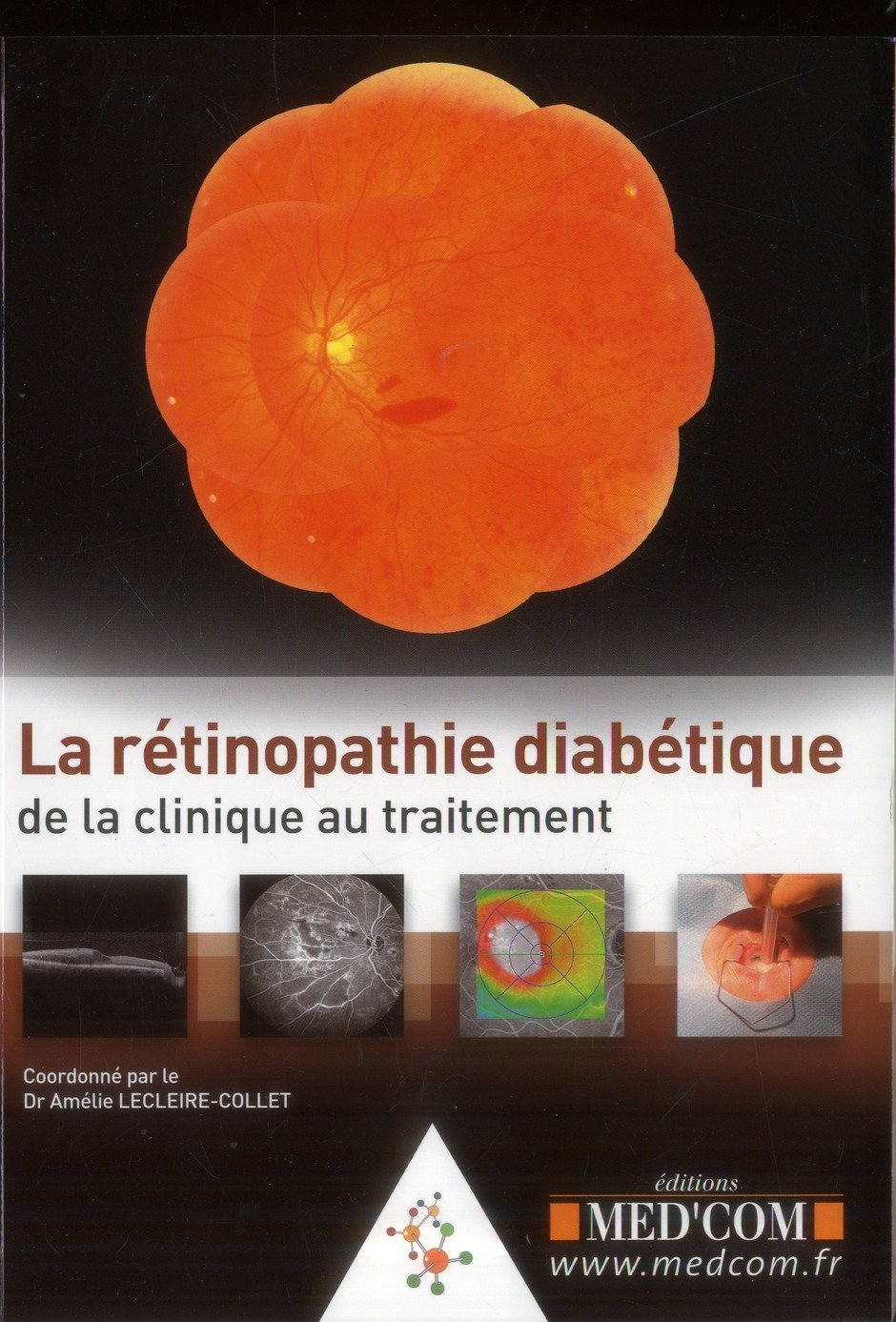 LA RETINOPATHIE DIABETIQUE :DE LA CLINIQUE AUTRAITEMENT (0000) book