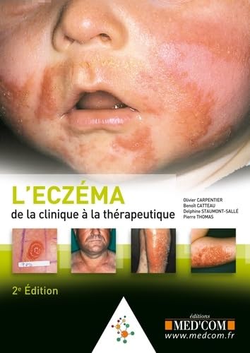 L ECZEMA. DE LA CLINIQUE AU TRAITEMENT. 2 ED (0000) book