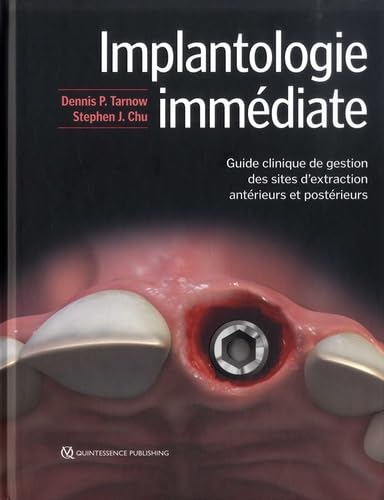 Implantologie immédiate: Guide clinique de gestion des sites d'extraction antérieurs et postérieurs book