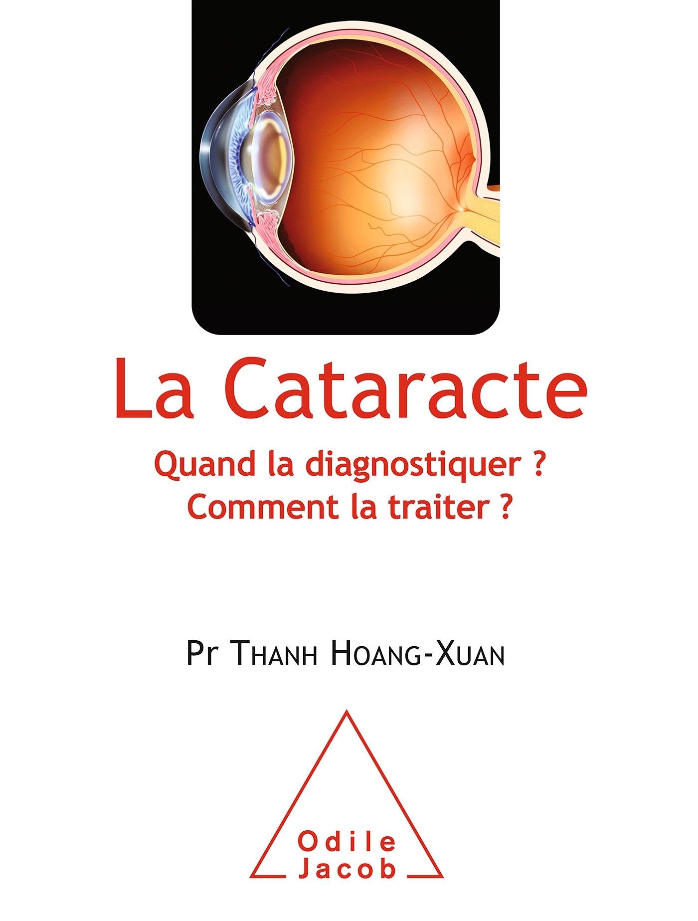 La Cataracte: Quand la diagnostiquer ? Comment la traiter ? Medicine