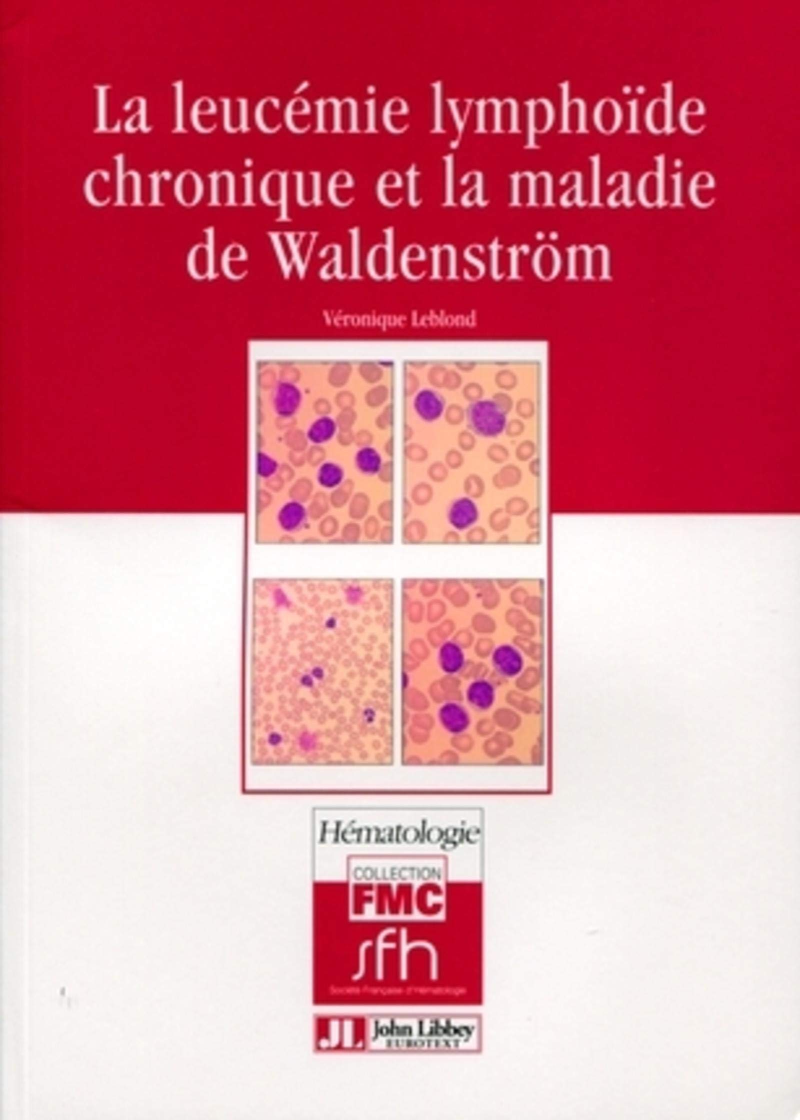 LA LEUCEMIE LYMPHOIDE CHRONIQUE ET LA MALADIE DE WALDENSTROM book