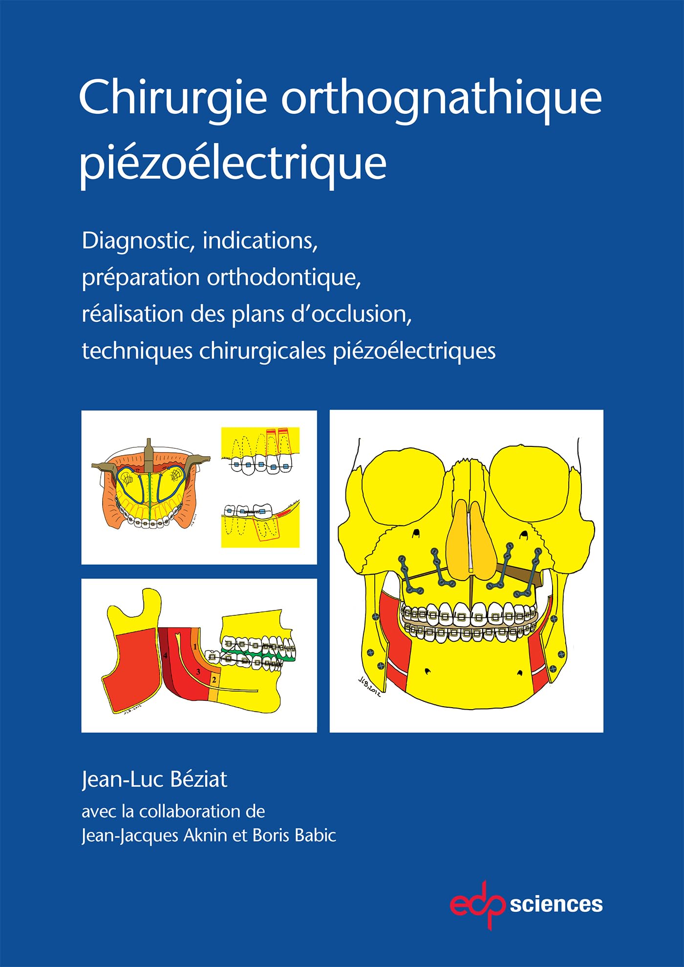 CHIRURGIE ORTHOGNATHIQUE PIEZOLECTRIQUE: Diagnostic, indications, préparation orthodontique, réalisation des plans d'occlusion, techniques chirurgicales piézoélectriques book