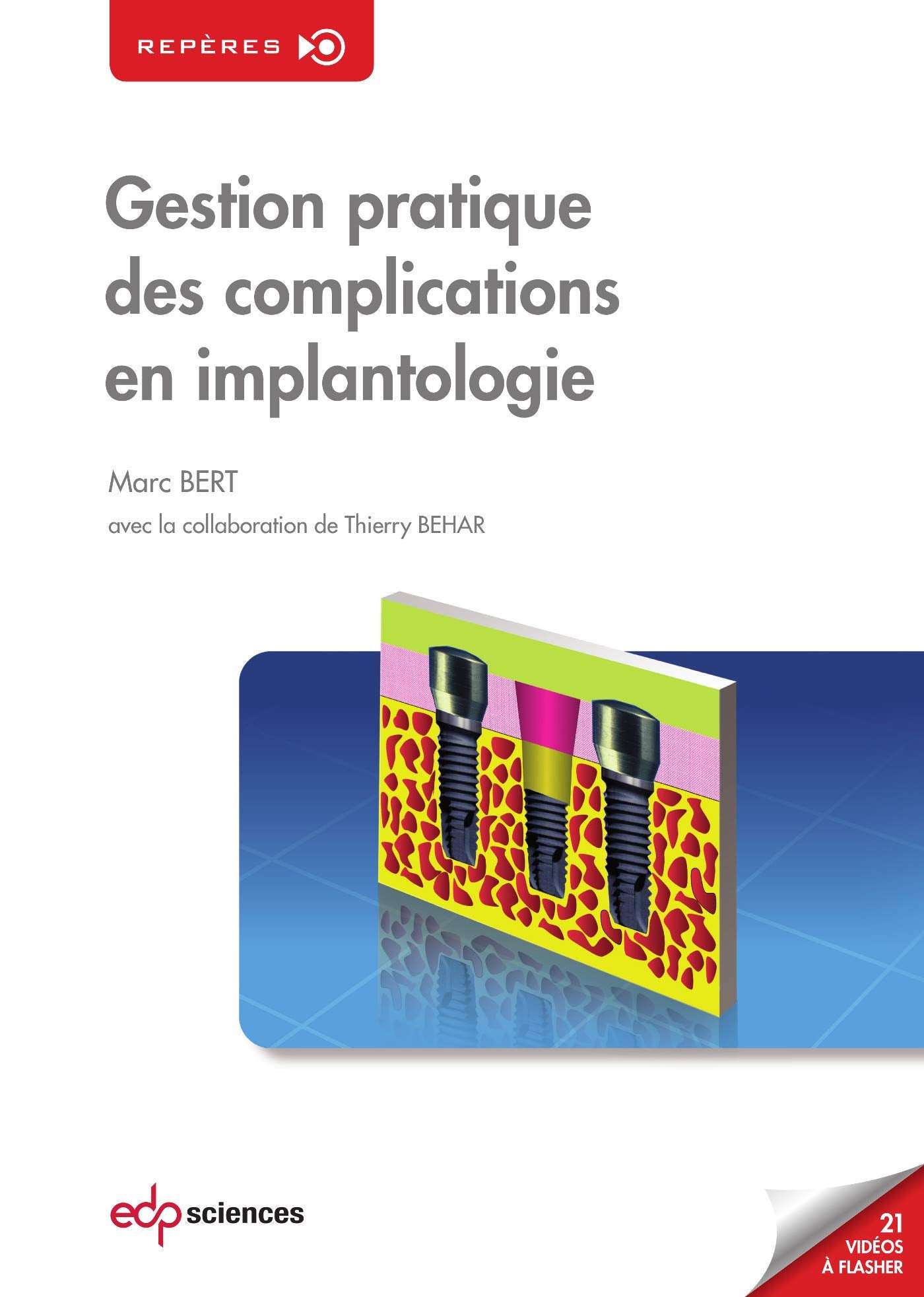 GESTION PRATIQUE DES COMPLICATIONS EN IMPLANTOLOGIE Medicine