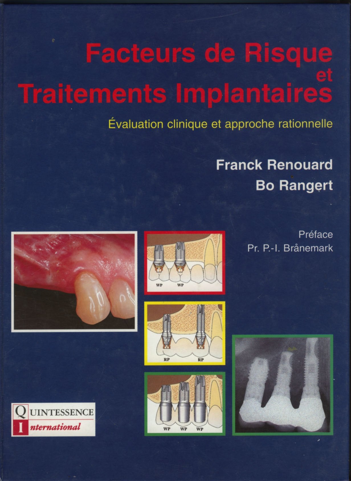 Facteurs De Risque Et Traitements Implantaires : Evaluation Clinique Et Approche Rationnelle Books