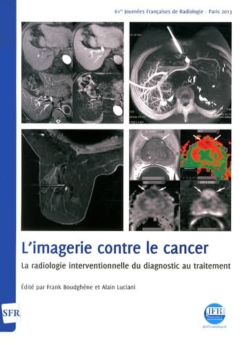 L'imagerie contre le cancer: La radiologie interventionnelle du diagnostic au traitement book