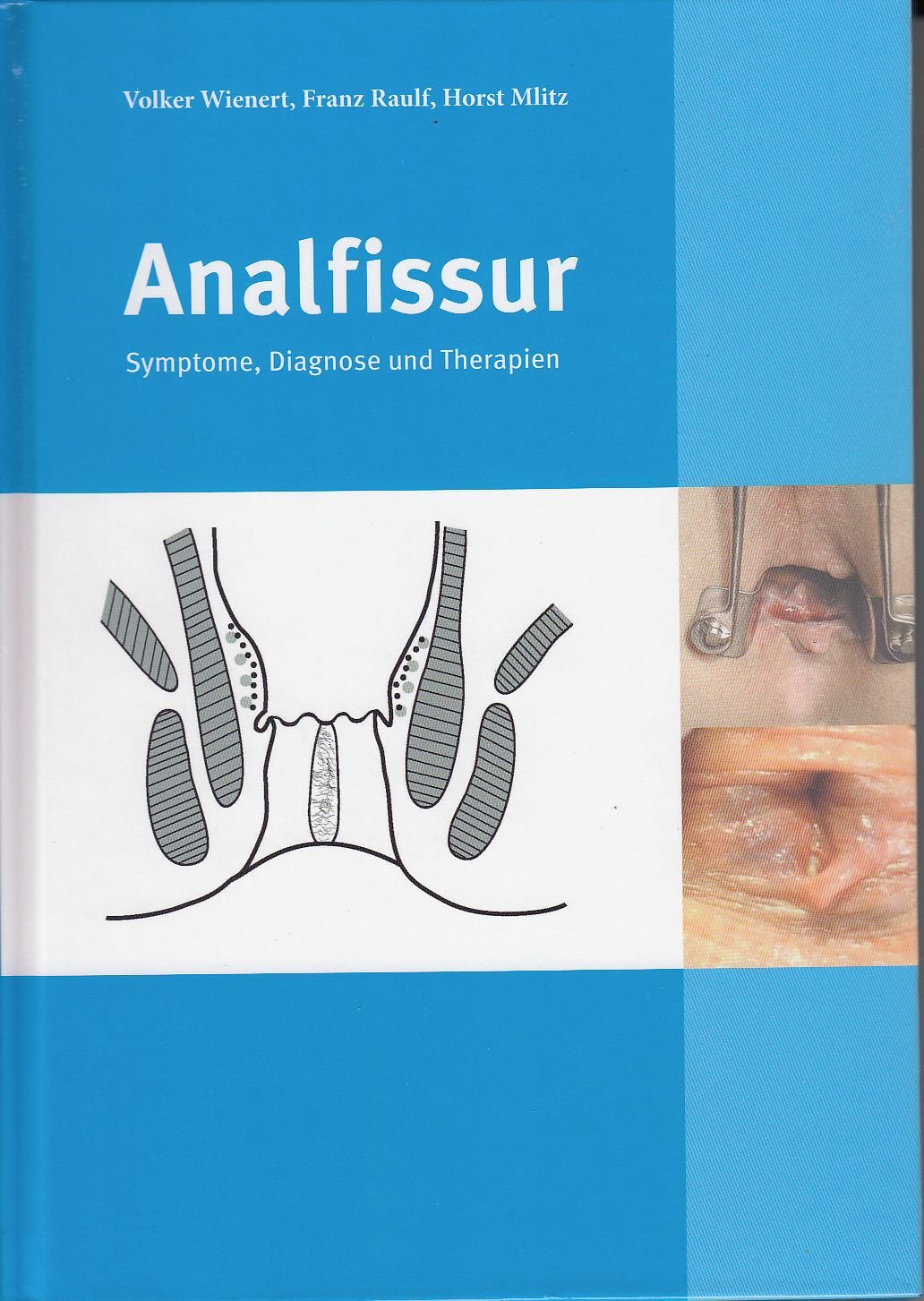 Analfissur - Symptome, Diagnose und Therapien Books