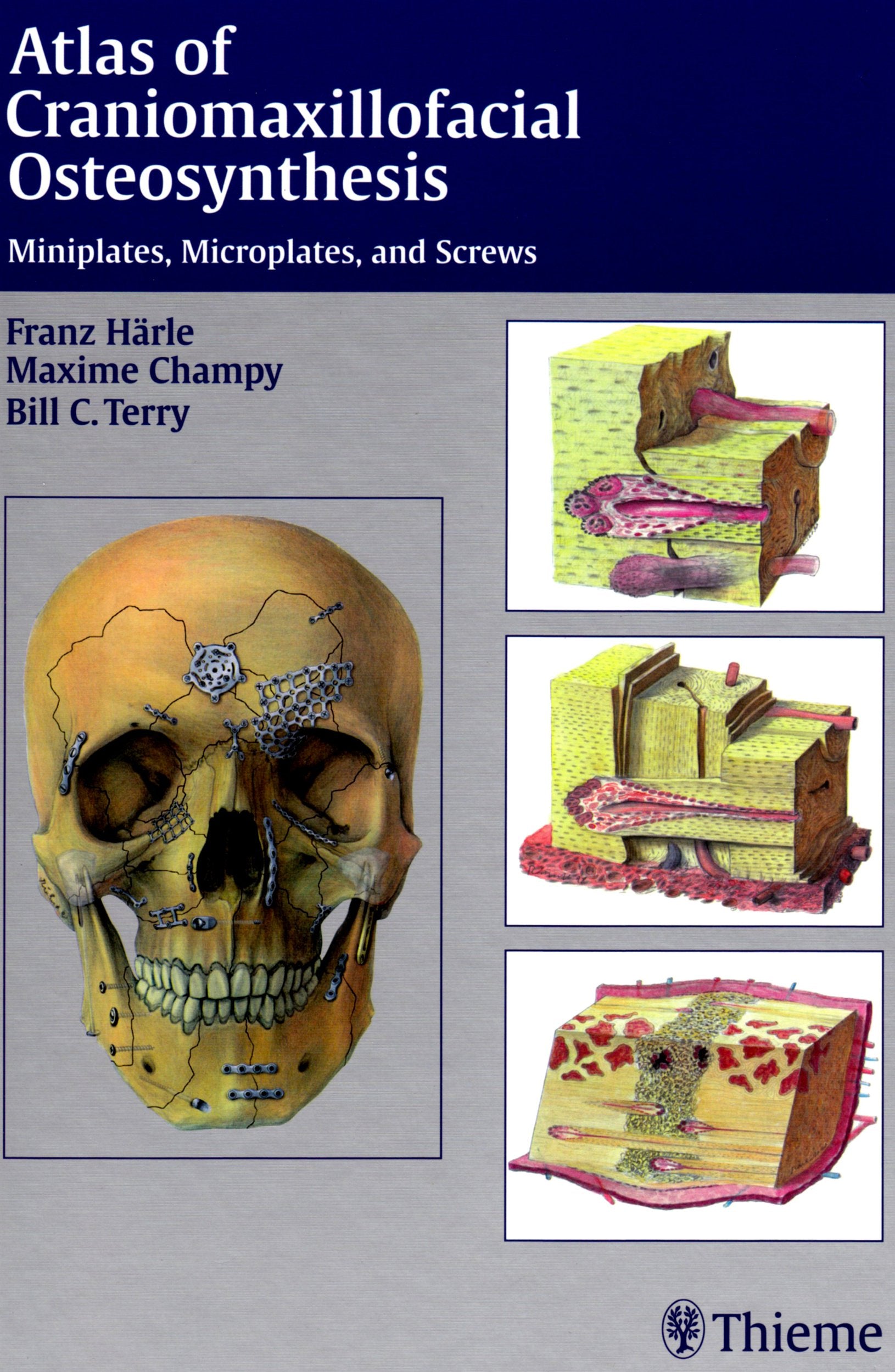 Atlas of Craniomaxillofacial Osteosynthesis: Microplates, Miniplates, and Screws: Micro-miniplates and Screws Medicine