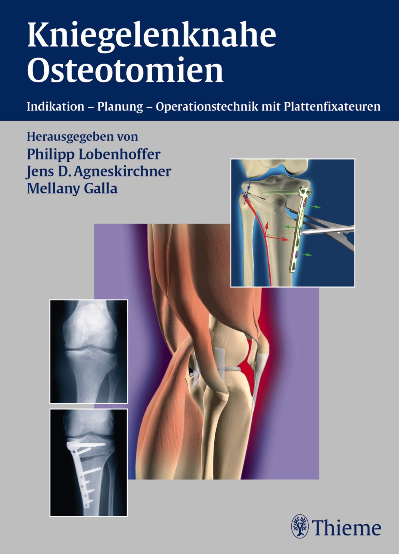 Kniegelenknahe Osteotomie: Indikation, Planung,Operationstechnik mit Plattenfixateuren Medicine