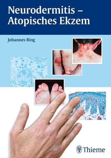 Neurodermitis - Atopisches Ekzem Medicine