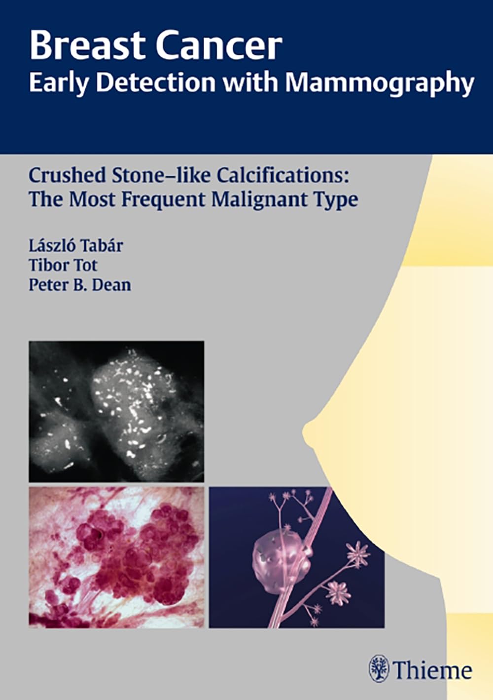 Breast Cancer: Early Detection with Mammography: Crushed Stone-like Calcifications: The Most Frequent Malignant Type (Tabar Mammo) Medicine