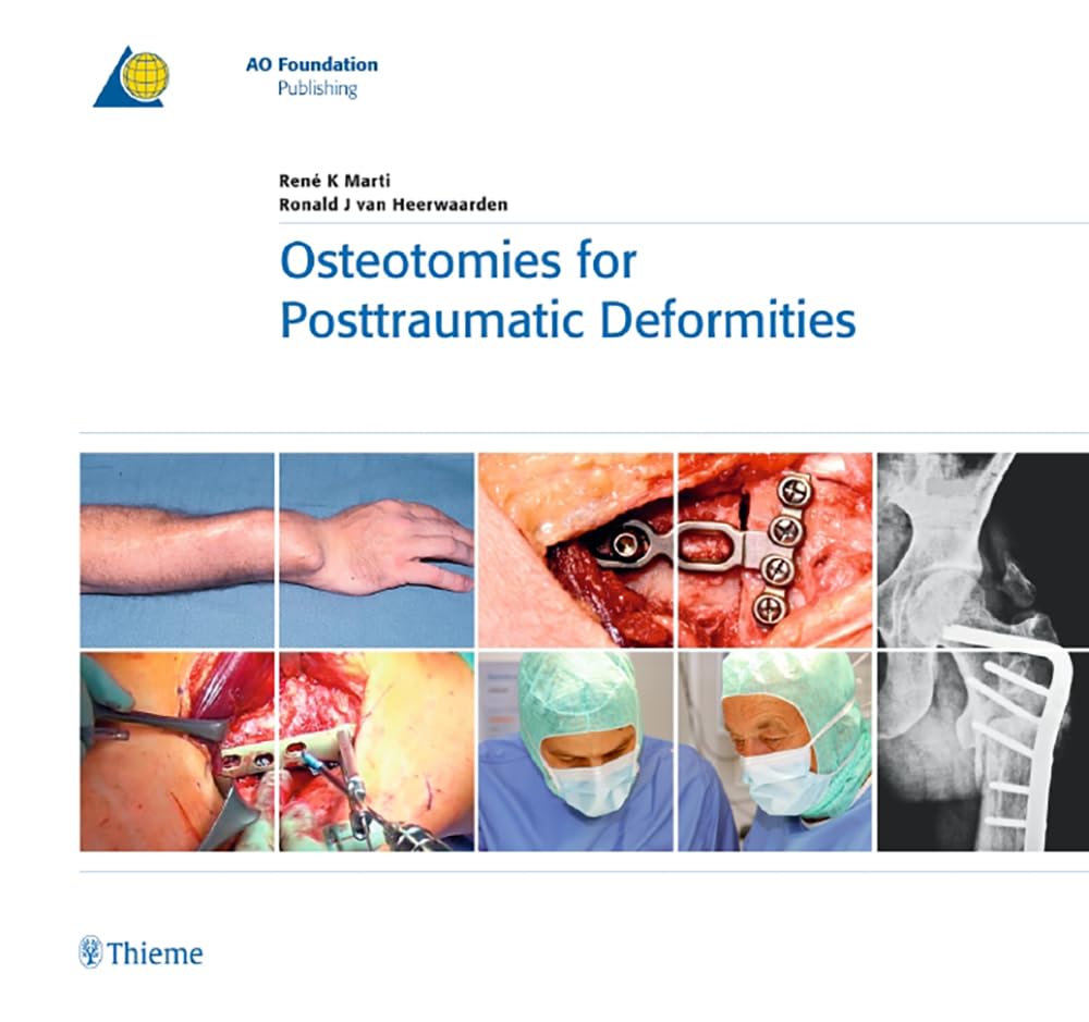 Osteotomies for Posttraumatic Deformities (AO-Publishing) Medicine