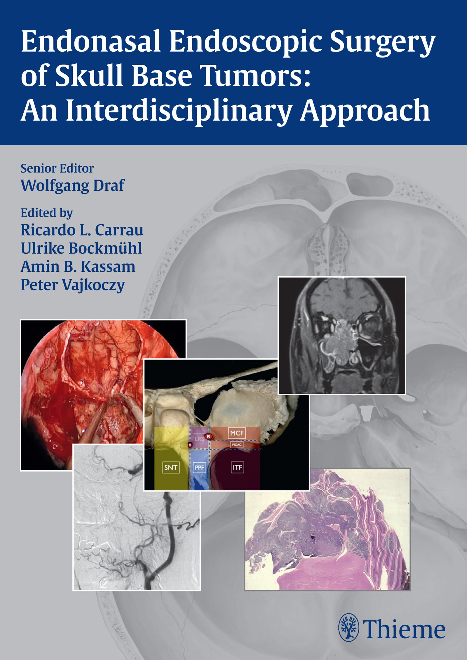 Endonasal Endoscopic Surgery of Skull Base Tumors: An Interdisciplinary Approach Medicine