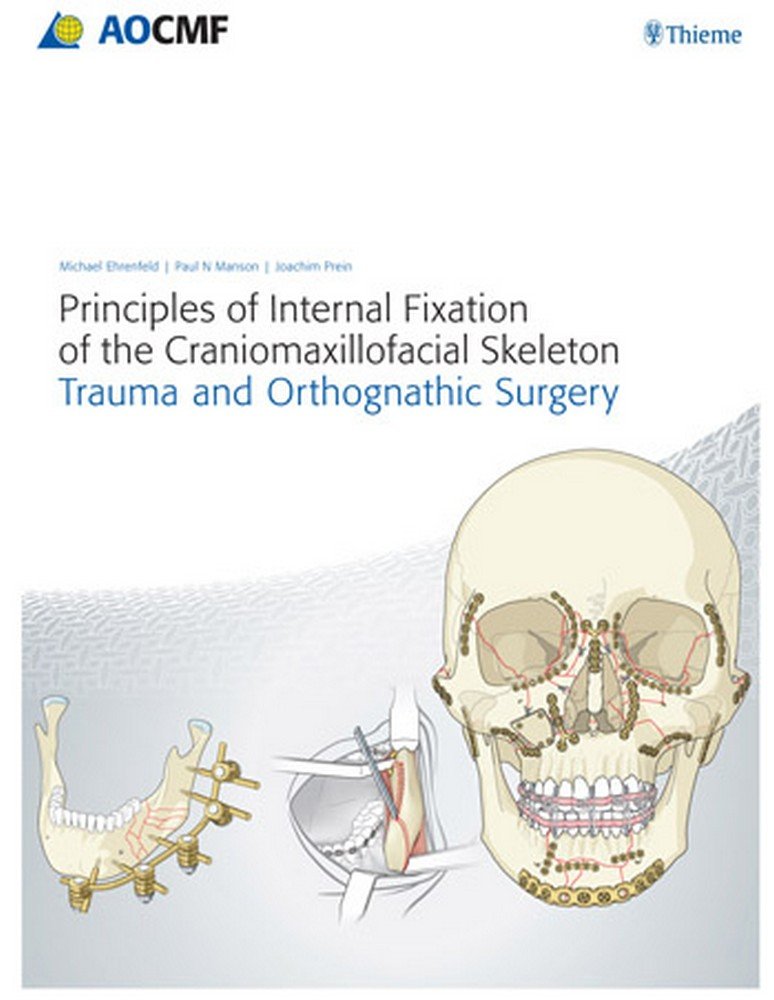 Principles of Internal Fixation of the Craniomaxillofacial Skeleton: Trauma and Orthognathic Surgery book
