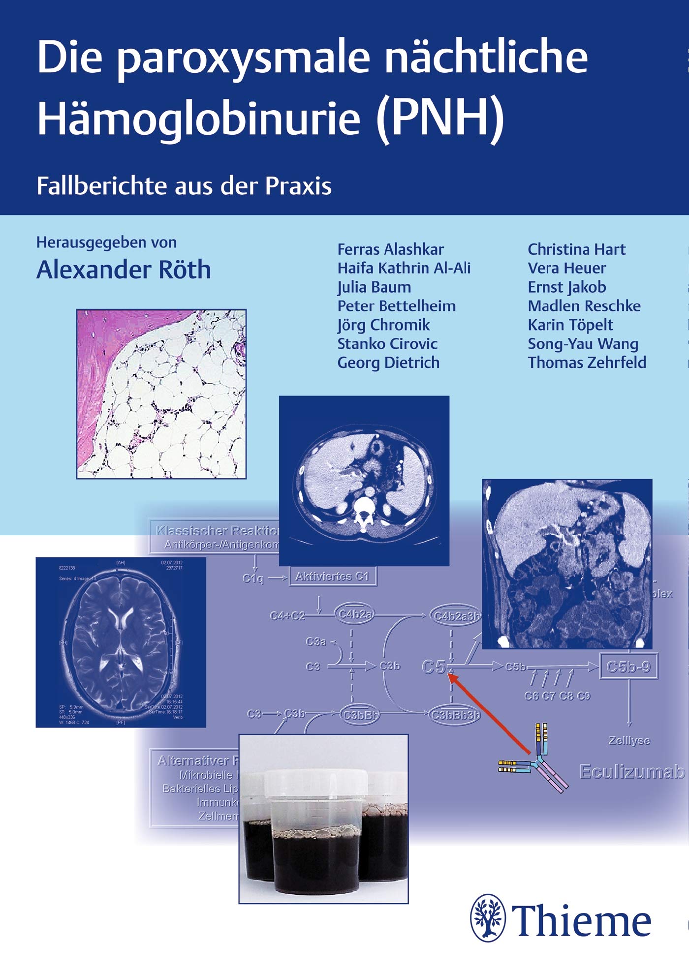 PNH - Paroxysmale nächtliche Hämoglobinurie: Fallberichte aus der Praxis Medicine
